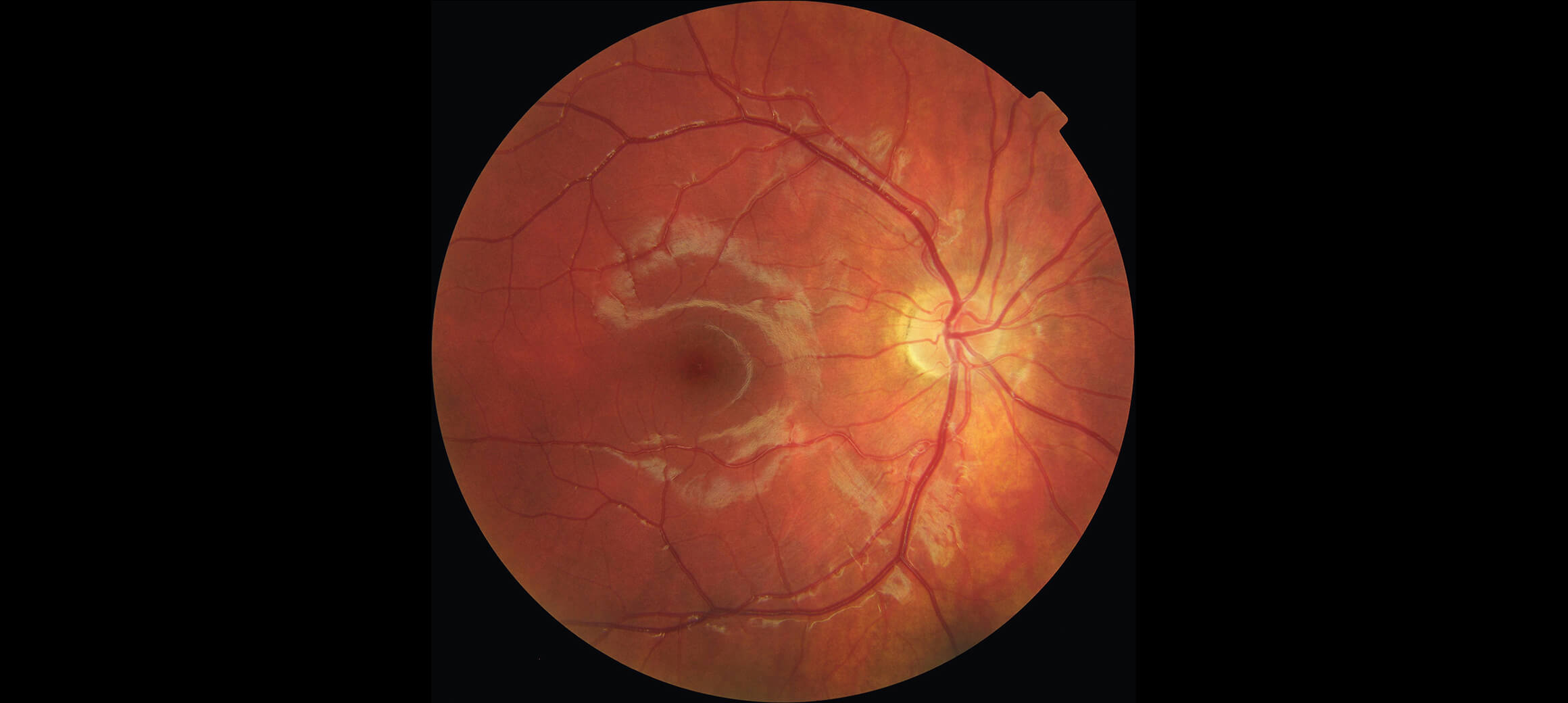 Eine Aufnahme der Retina, die (in diesem Fall) altersbedingte Makuladegeneration aufweist.
